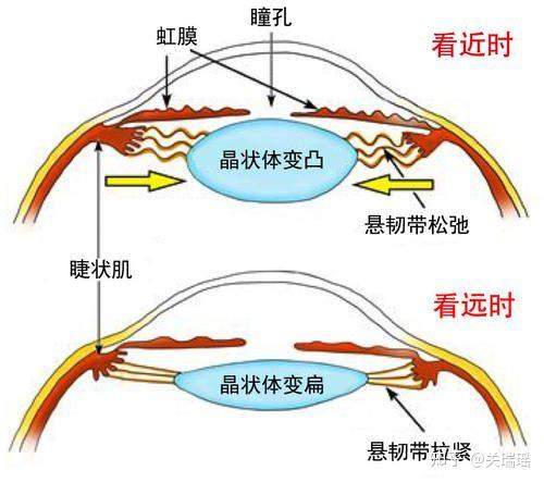 锻炼睫状体有什么用可以增加睫状体的力量大小吗如果可以是不是就可以