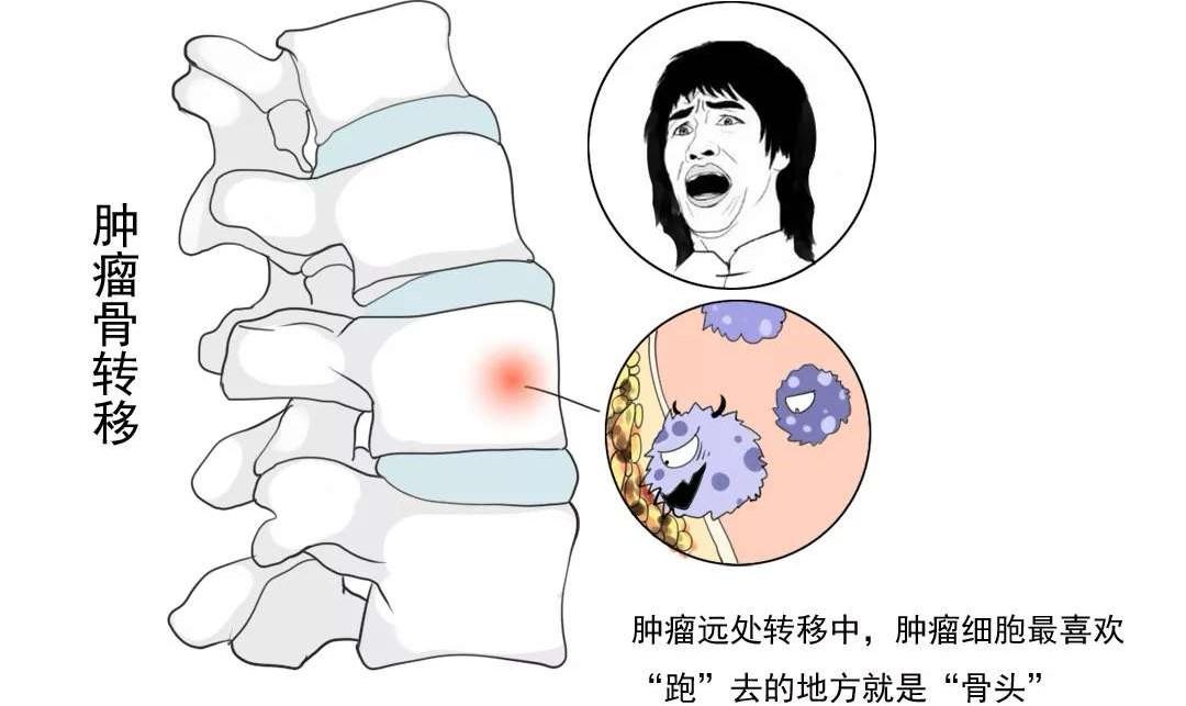 乳腺癌若发生骨转移可能会出现哪些信号呢