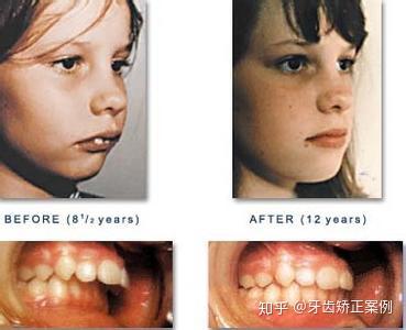 10到16岁牙齿矫正的最佳时期,青少年不容错过!