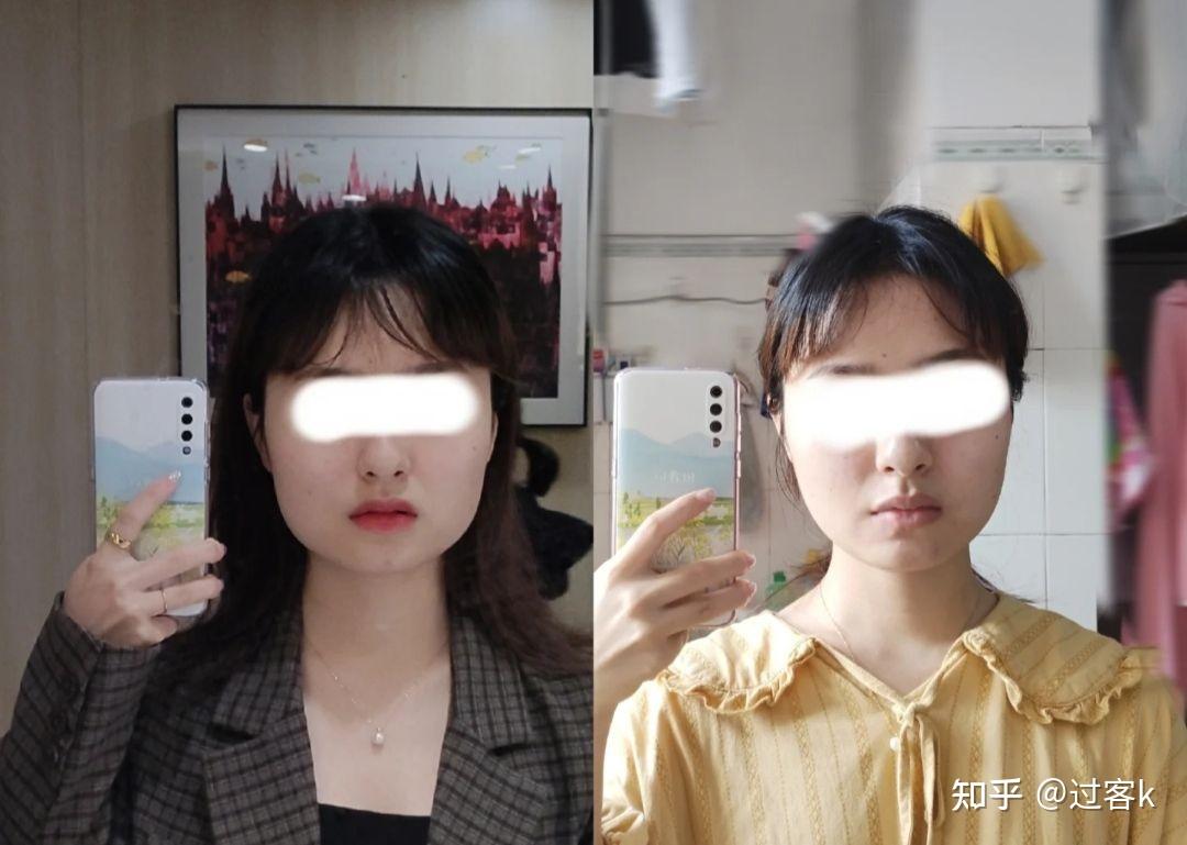 请问咬肌肥大按摩到底有没有用啊