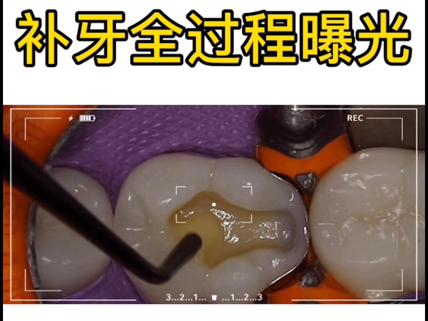 【深圳补牙】过程是怎样的呢?557           赞同视频