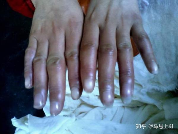每个手指都是冻疮,你知道是什么感受么?