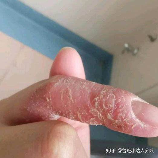 如何区分手指皮肤开裂是真菌还是湿疹