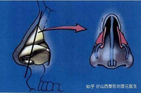 鼻头结构————鼻翼软骨 这个鼻翼软骨捏,有内侧脚和外侧脚,在鼻孔