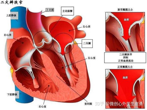 浙江省人民医院崔勇医生:心脏瓣膜修复手术术后注意事项