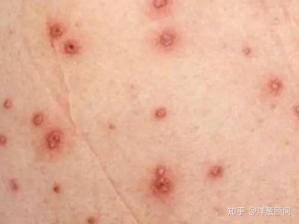 成人也会得水痘吗病毒多发季节你需要注意的事