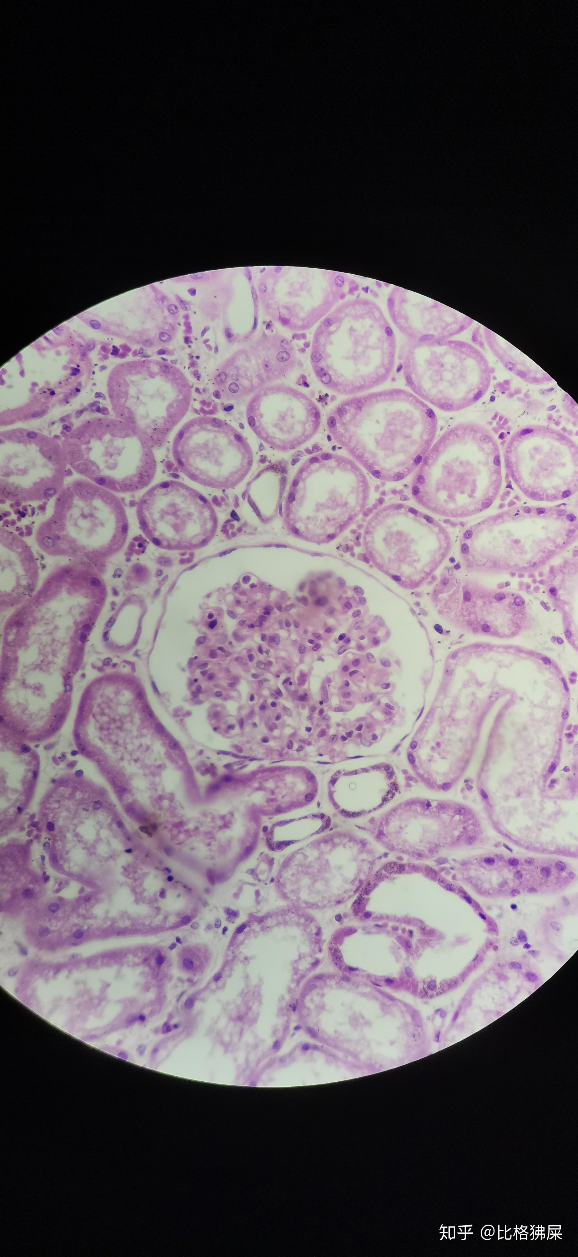 绘图要求:绘出肾小球体积增大,细胞(即内皮细胞和系膜细胞)数量增多