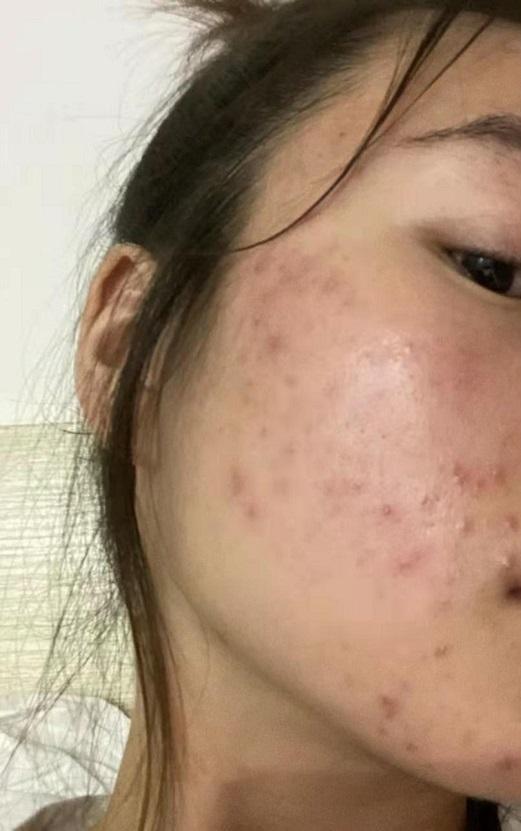 脸上有痘坑还能拥有爱情吗?