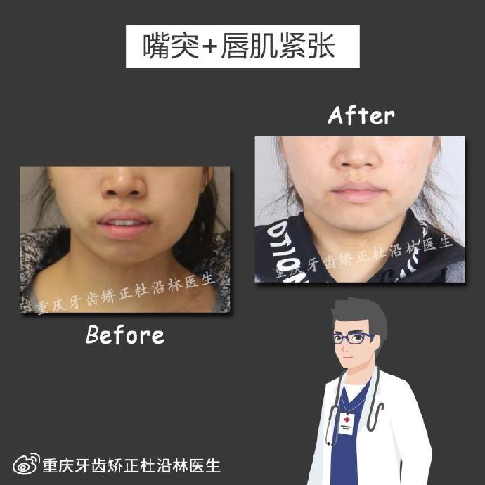 du的正畸案例篇1】1 人赞同了该文章第四军医大学 口腔医学硕士牙齿
