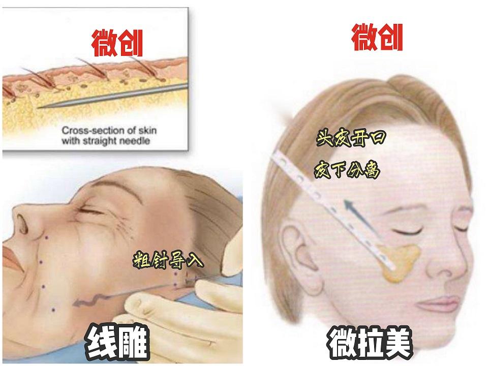 微拉美和线雕都是通过可吸收生物材料来做悬吊的手术方式, 线雕是靠有