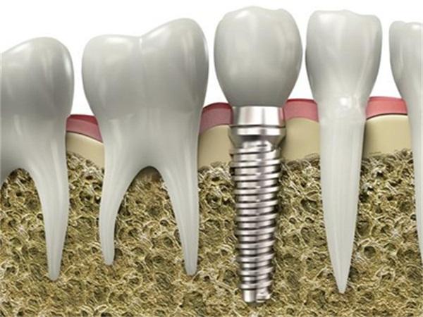 回龙观种植牙-荷马口腔种植牙的风险如何避免?