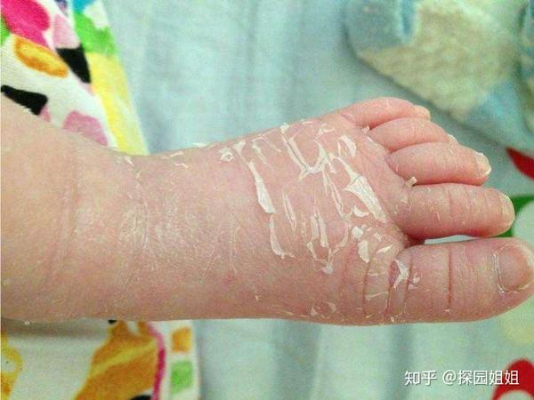 探园育儿新生儿为什么会蜕皮宝宝肌肤正确护理干货都在这啦