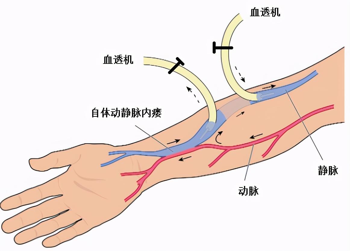 动静脉内瘘血管狭窄 ▏确保"生命通路"畅通,球囊扩张介入治疗