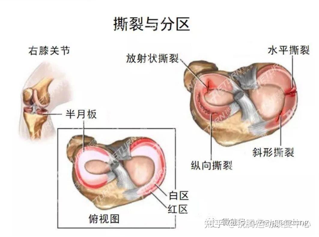 但是,如果撕裂口在关节腔内发生扭转而分离扩大,那么半月板就会变得很
