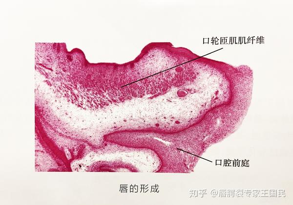 第5~6周时,口腔前庭已形成口唇,上皮明显增厚,唇黏膜与牙槽黏膜分开