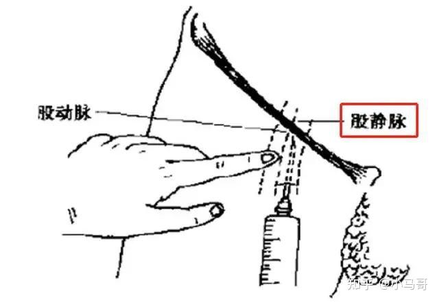 一次性头皮针,采血试管 股静脉定位 触摸法:左手在腹股沟区触摸股动脉
