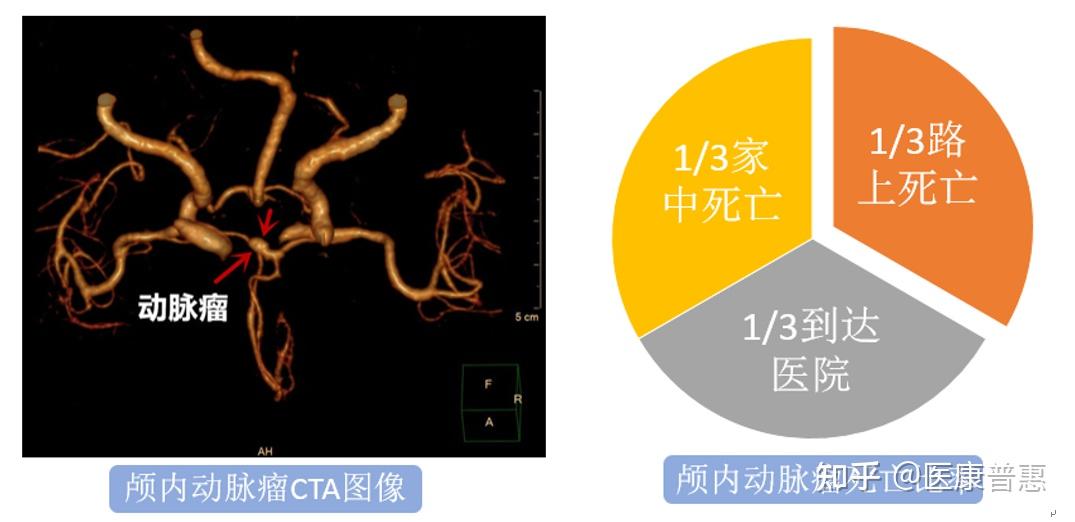 动脉瘤是由于动脉壁的病变或损伤,形成动脉壁局限性或弥漫性扩张或