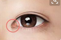 泪阜就是眼角处呈卵圆形,隆起的那部分红色组织 有些人因为内眦赘