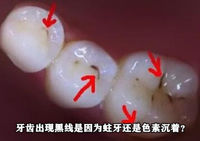 牙齿出现黑线是因为蛀牙还是色素沉着