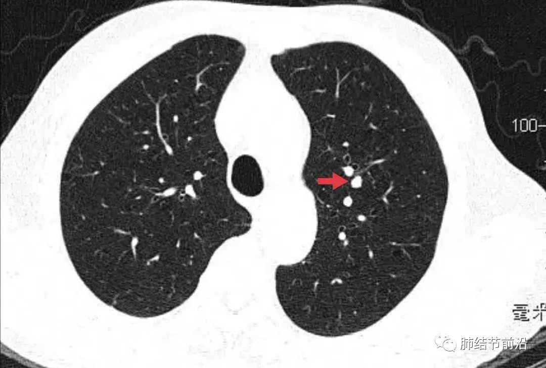 肺结节读片(14):不需要随访的的良性肺结节