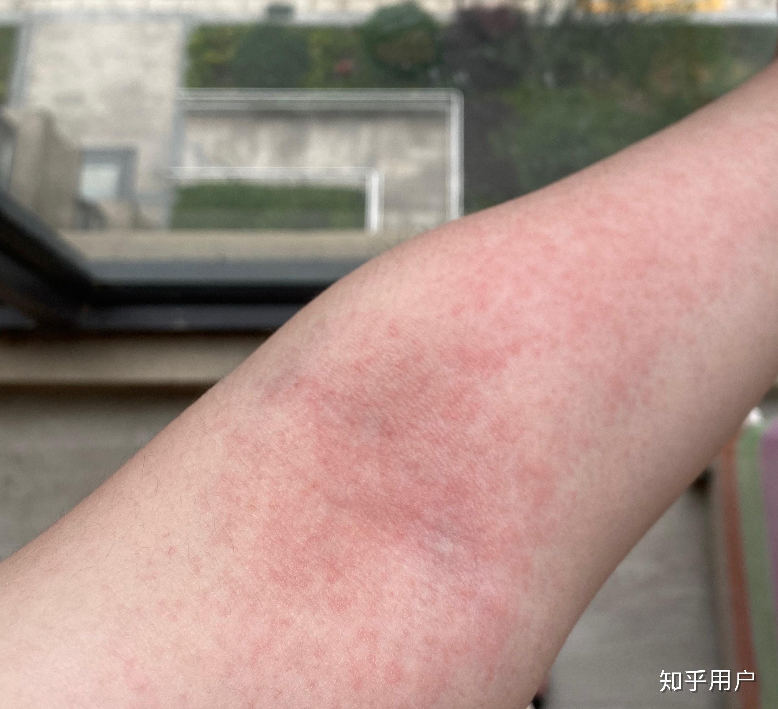 酒精过敏的人喝多了会怎么样