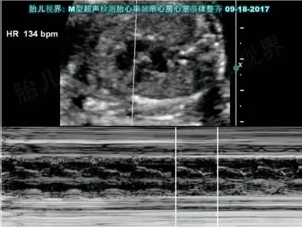 图一 未饮用咖啡的孕妈的胎儿心脏超声m型显示,心房和心室的节律