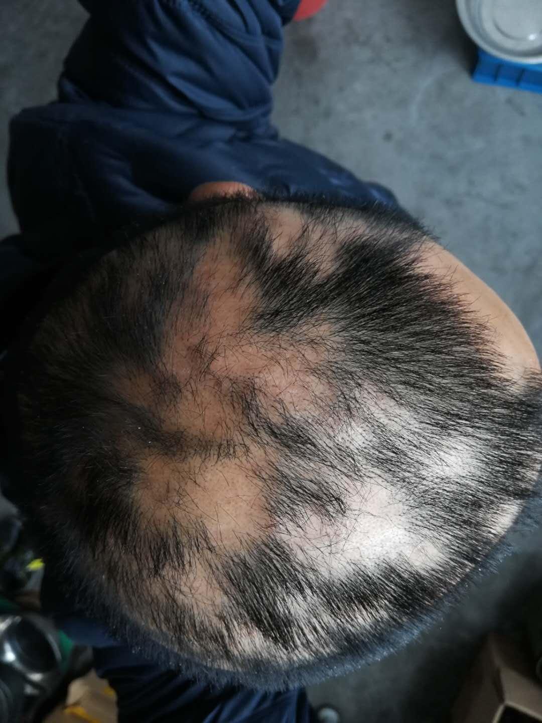 皮肤科医生说是斑秃,中医科说斑秃和脂溢性脱发都有,到底怎么治?