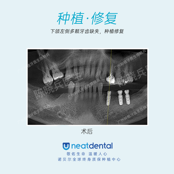 左侧下颌的种植牙修复,种植三颗植体,连冠搭桥恢复四颗牙齿的咬合功能
