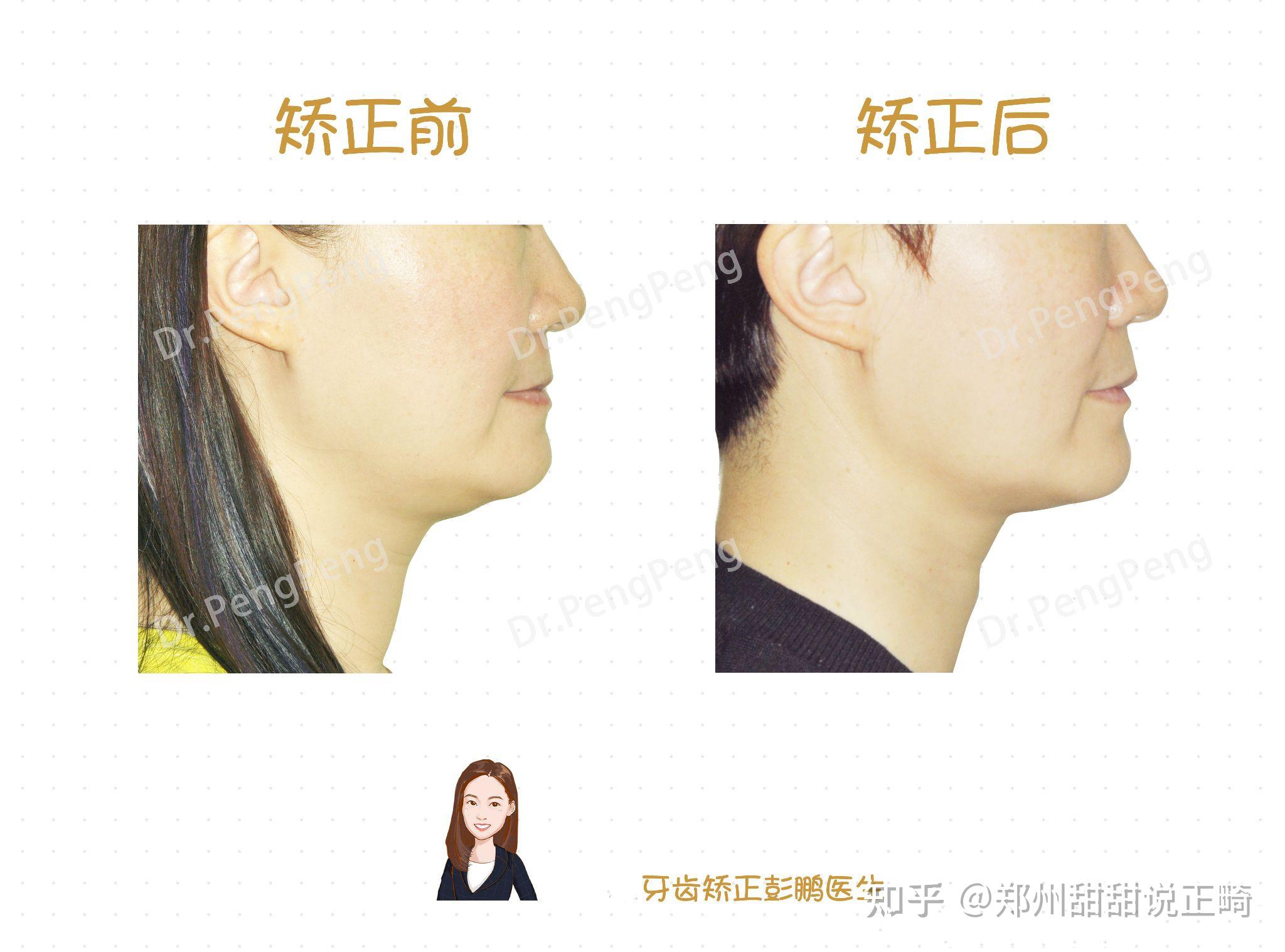 但地包天未解决,长年的错误咬合导致前牙切断