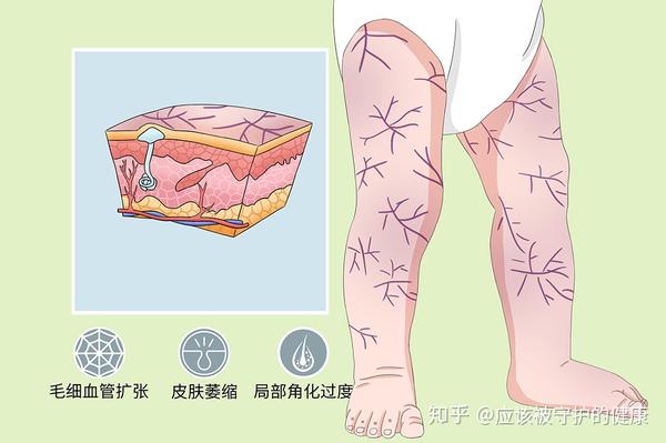 肌营养不良的症状