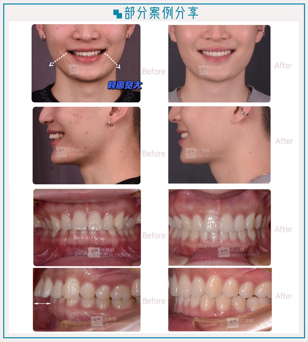 成都牙齿矫正代育桐院长成都隐适美案例数top1