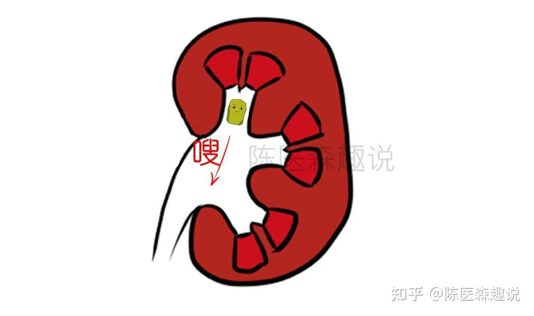 倒立排出肾结石是什么原理