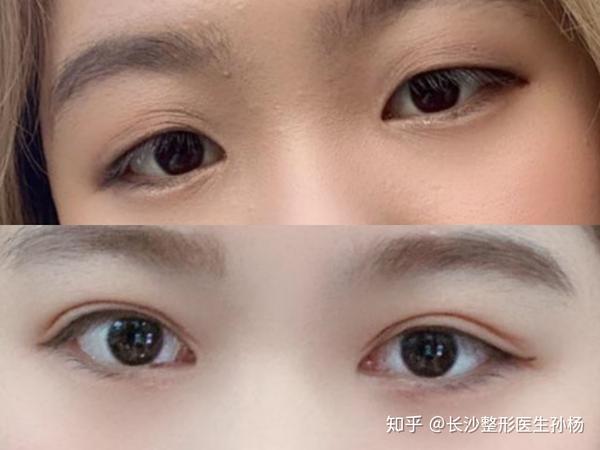 长沙双眼皮案例分享