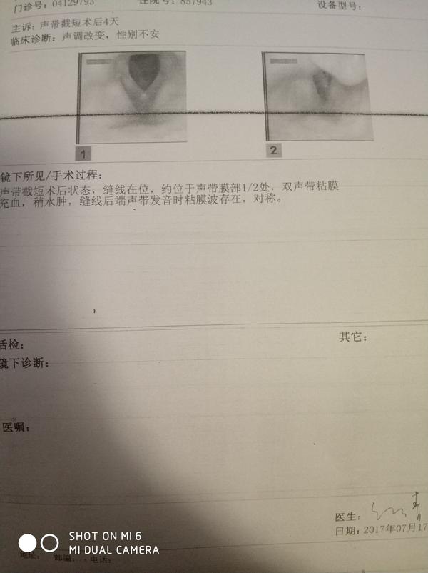 关于声带手术的一些内容