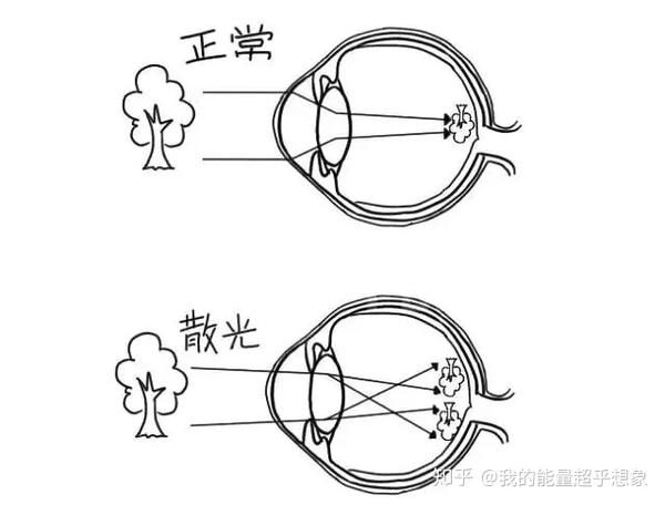 散光看东西是什么样的?