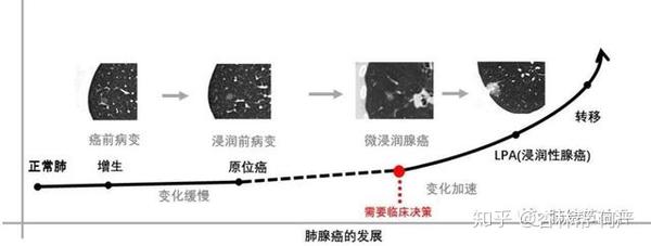 今天,我们来深入了解肺原位癌