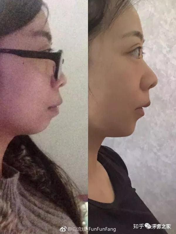 骨性龅牙,下巴后缩,凸嘴怎么改善侧脸?