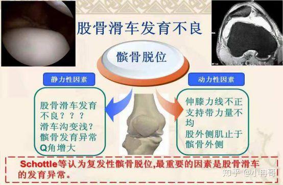 发育不全,髌骨容易往外跑,这种种先天因素导致人更容易发生髌骨软骨