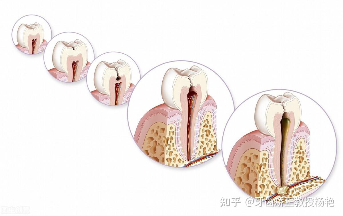 为什么医院不补浅龋齿