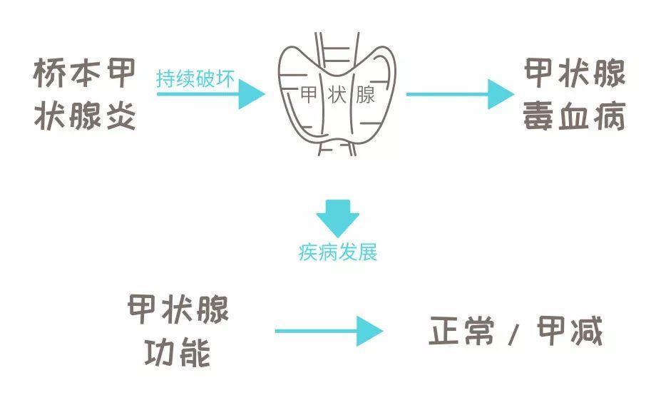 桥本甲状腺炎病程就像坐过山车一样