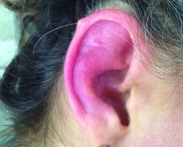 没骨气的耳朵复发性多软骨炎好发于4055岁