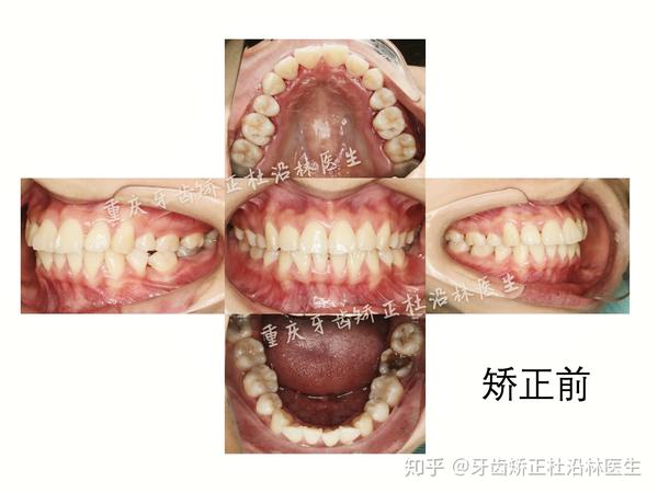 重庆牙齿矫正杜沿林:二次矫正,通过双牙列远移内收牙齿,解决前突问题