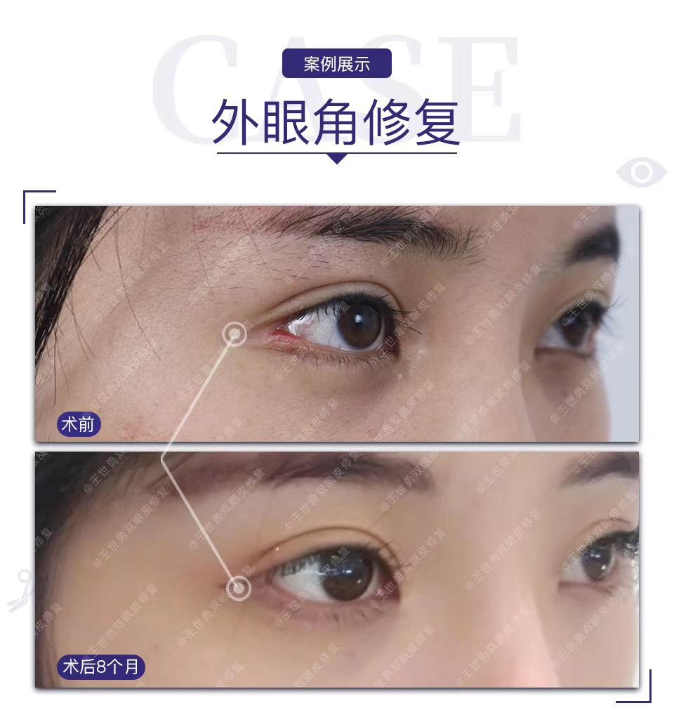 王世勇单侧外眼角修复术后8个月