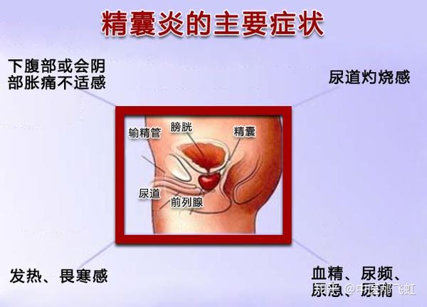 精囊炎的主要症状是什么看一看中医辩证分型论治精囊炎