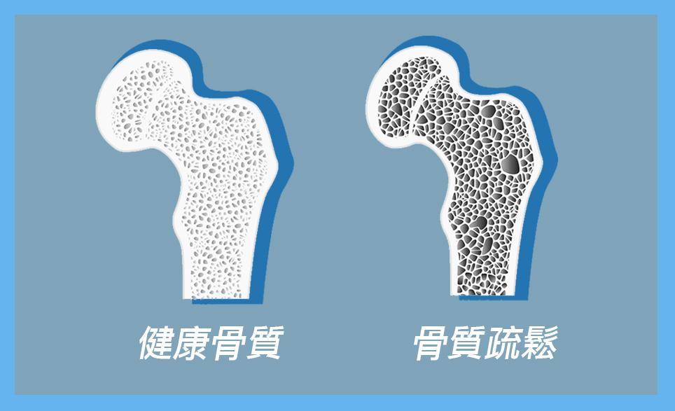 为何年纪轻轻就会有骨质疏松