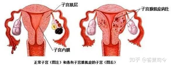 卵巢囊肿不手术能自己消失么