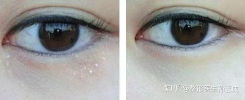 这种眼部脂肪粒怎么去除?