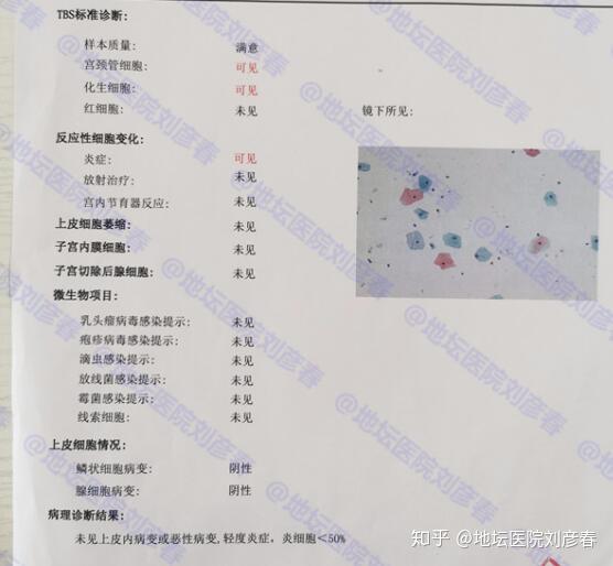 tct报告提示有炎症是怎么回事是否需要治疗