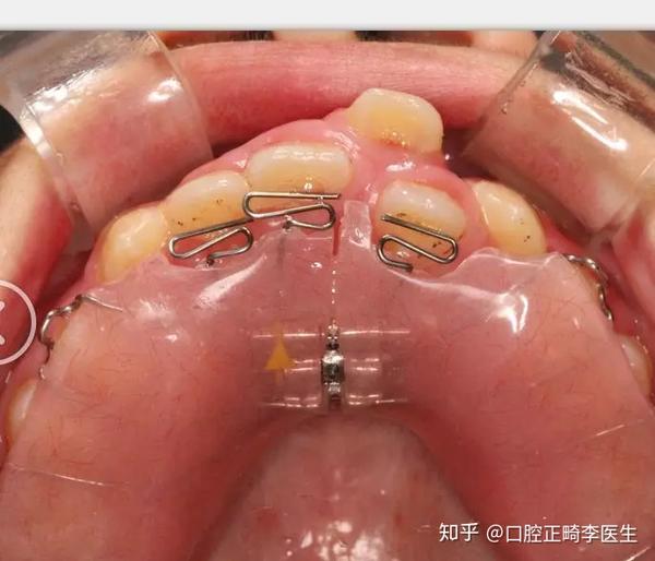 在活动矫治器上加一些弹簧等辅助装置,移动个别牙齿,扩大牙弓等.