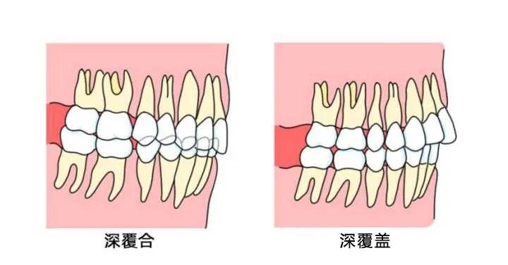 矫正牙齿中的深覆合和深覆盖有什么区别呢?